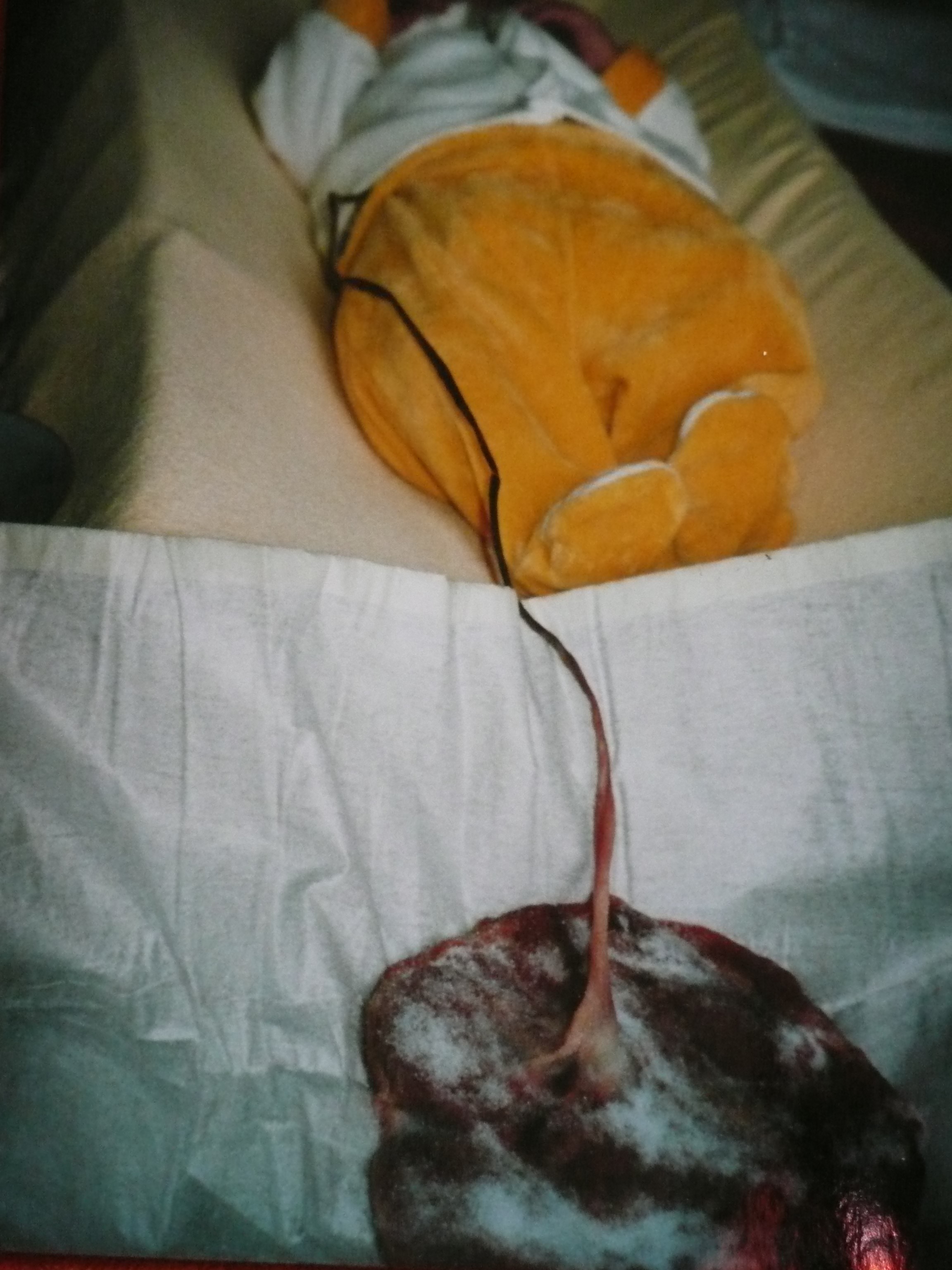 lotus birth placenta